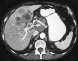 Islet Cell Tumor in Porta and Liver - CTisus CT Scan