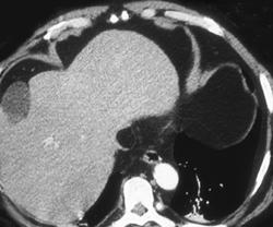 Pseudo clot in Inferior Vena Cava (IVC) - CTisus CT Scan