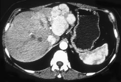 Focal Nodular Hyperplasia (FNH) - CTisus CT Scan