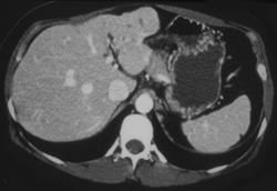 Focal Nodular Hyperplasia (FNH) - CTisus CT Scan