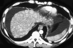 Wilsons Disease - CTisus CT Scan