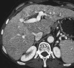 Av Fistulae - CTisus CT Scan