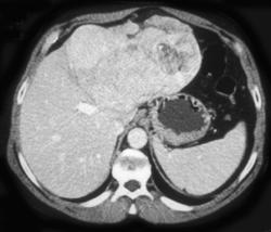 Hepatoma - CTisus CT Scan