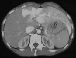 Lymphoma With Hot Spot Liver - CTisus CT Scan