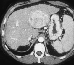 Hepatoma - CTisus CT Scan