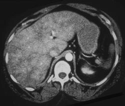 Cirrhosis - CTisus CT Scan