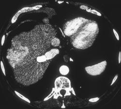 Multifocal Hepatoma in A Cirrhotic Liver - CTisus CT Scan