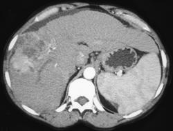 Hepatoma - CTisus CT Scan