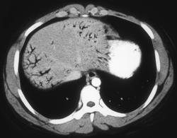 Air in the Portal Vein S/P ERCP - CTisus CT Scan