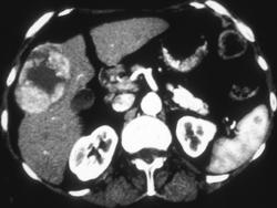 Hepatoma - CTisus CT Scan