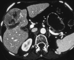 Hepatoma - CTisus CT Scan