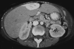 Hot Spot Liver Due to SVC Obstruction - CTisus CT Scan