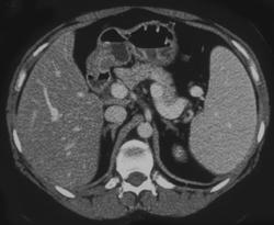 Early Cirrhosis - CTisus CT Scan