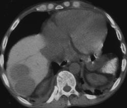 Extramedullary Hematopoesis in Sickle Cell Disease - CTisus CT Scan