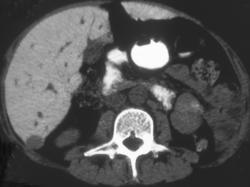 Sickle Cell Disease W/ Dense Liver - CTisus CT Scan