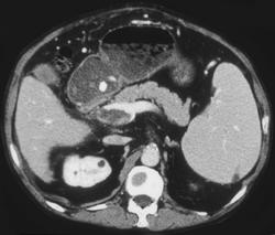 Cirrhosis and Portal Vein Thrombosis - CTisus CT Scan