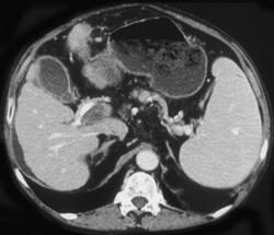 Portal Vein Thrombosis - CTisus CT Scan