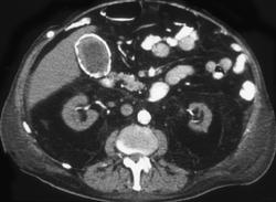 Porcelan Gallbladder - CTisus CT Scan