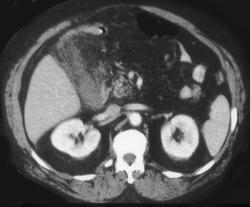 Acute Cholecystitis - CTisus CT Scan