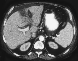 Hepatoma - CTisus CT Scan