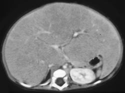 Metastatic Neuroblastoma - CTisus CT Scan