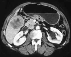 Hepatoma - CTisus CT Scan