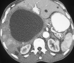 Huge Hepatic Cyst With Flow Changes in the Liver - CTisus CT Scan