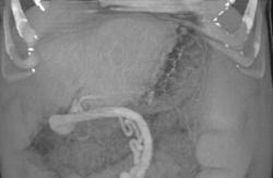 Large Umbilical Vein - CTisus CT Scan