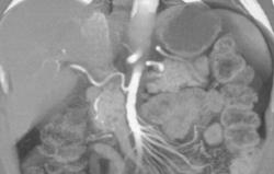 Hepatic Artery Arises Off the SMA - CTisus CT Scan