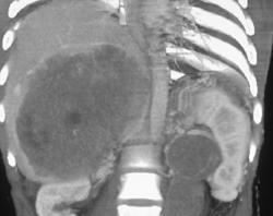 Islet Cell Tumor Metastatic to the Liver and Left Renal Hilum - CTisus CT Scan