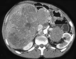 Metastatic Islet Cell Tumor - CTisus CT Scan