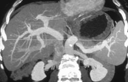 Cirrhosis - CTisus CT Scan