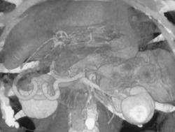 Cirrhosis With Varices - CTisus CT Scan