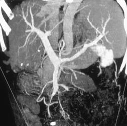 Cirrhosis - CTisus CT Scan