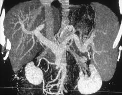 Cirrhosis With Varices - CTisus CT Scan