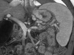 Cirrhosis With Varices - CTisus CT Scan