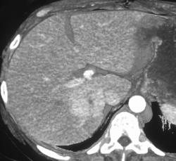 Multiple Masses- Proven Focal Nodular Hyperplasia (FNH) in Rt. Lobe & Hemangioma in Left Lobe - CTisus CT Scan