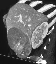 Hepatoma - CTisus CT Scan