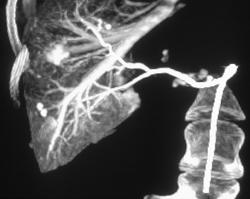 Direct Catheter Injection & Liver CTA - CTisus CT Scan