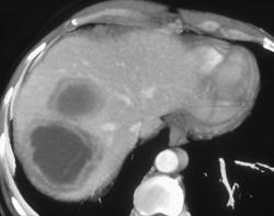 Amebic Abscesses - CTisus CT Scan