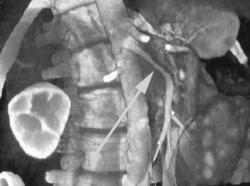 SMA Is Encased By Tumor - CTisus CT Scan