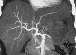 Cirrhosis - CTisus CT Scan