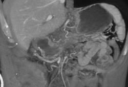 Pancreatic Cancer With Portal Vein Thrombosis - CTisus CT Scan