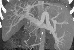 Cirrhosis With Varices - CTisus CT Scan