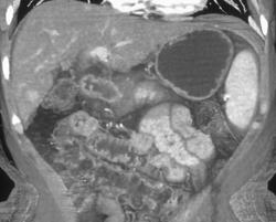 Cirrhosis - CTisus CT Scan