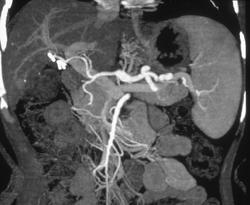 Normal Hepatic Artery Anatomy - CTisus CT Scan