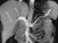 VRT Vs MIP of Hepatic Venous Anatomy - CTisus CT Scan