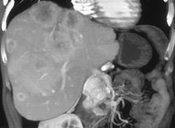 Metastatic Islet Cell Tumor of the Pancreas (see Enhancing Pancreatic Head Mass) - CTisus CT Scan