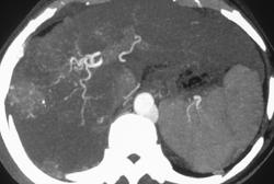 Hepatoma With Neovascularity - CTisus CT Scan