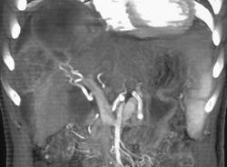 Hepatoma - CTisus CT Scan